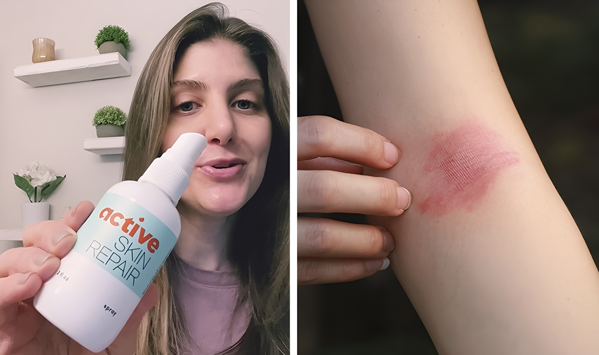Eczema ATF 1