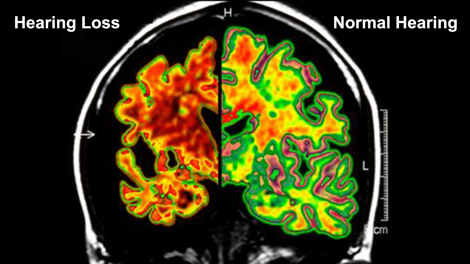 MRI