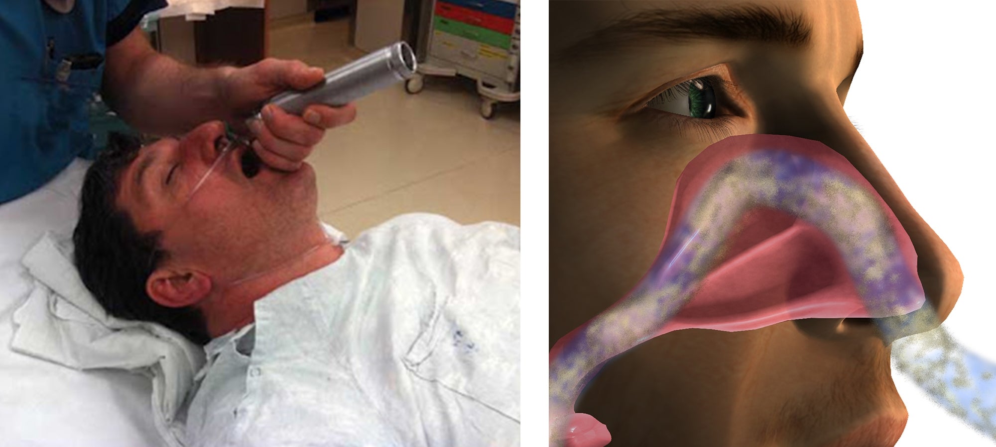 I Intake Adv Nasal Surgery