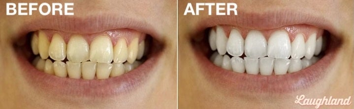 Laughland before after